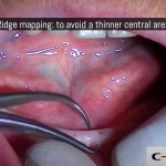 03-clinical-case-SD-Mini-dental-implant-_-Flapless-Technique.-Dottor-Aldo-De-Blasi