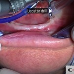 04-clinical-case-SD-Mini-dental-implant-_-Flapless-Technique.-Dottor-Aldo-De-Blasi
