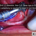 05-clinical-case-SD-Mini-dental-implant-_-Flapless-Technique.-Dottor-Aldo-De-Blasi
