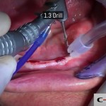 06-clinical-case-SD-Mini-dental-implant-_-Flapless-Technique.-Dottor-Aldo-De-Blasi