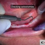 07-clinical-case-SD-Mini-dental-implant-_-Flapless-Technique.-Dottor-Aldo-De-Blasi