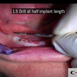 08-clinical-case-SD-Mini-dental-implant-_-Flapless-Technique.-Dottor-Aldo-De-Blasi