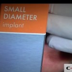 09-clinical-case-SD-Mini-dental-implant-_-Flapless-Technique.-Dottor-Aldo-De-Blasi