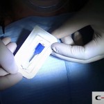 11-clinical-case-SD-Mini-dental-implant-_-Flapless-Technique.-Dottor-Aldo-De-Blasi