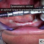 15-clinical-case-SD-Mini-dental-implant-_-Flapless-Technique.-Dottor-Aldo-De-Blasi