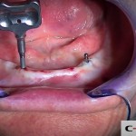 17-clinical-case-SD-Mini-dental-implant-_-Flapless-Technique.-Dottor-Aldo-De-Blasi