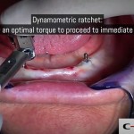 18-clinical-case-SD-Mini-dental-implant-_-Flapless-Technique.-Dottor-Aldo-De-Blasi