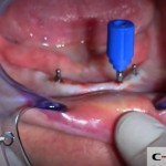 19-clinical-case-SD-Mini-dental-implant-_-Flapless-Technique.-Dottor-Aldo-De-Blasi