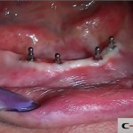 20-clinical-case-SD-Mini-dental-implant-_-Flapless-Technique.-Dottor-Aldo-De-Blasi