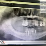 04-aprile-C-tech-Implant-corso-teorico-pratico-pazienti-2021-quadrato