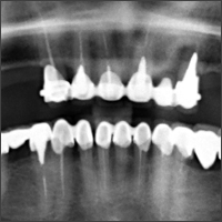 Henriette-Lerner-dental-implant-connessione-conica-conical-connection