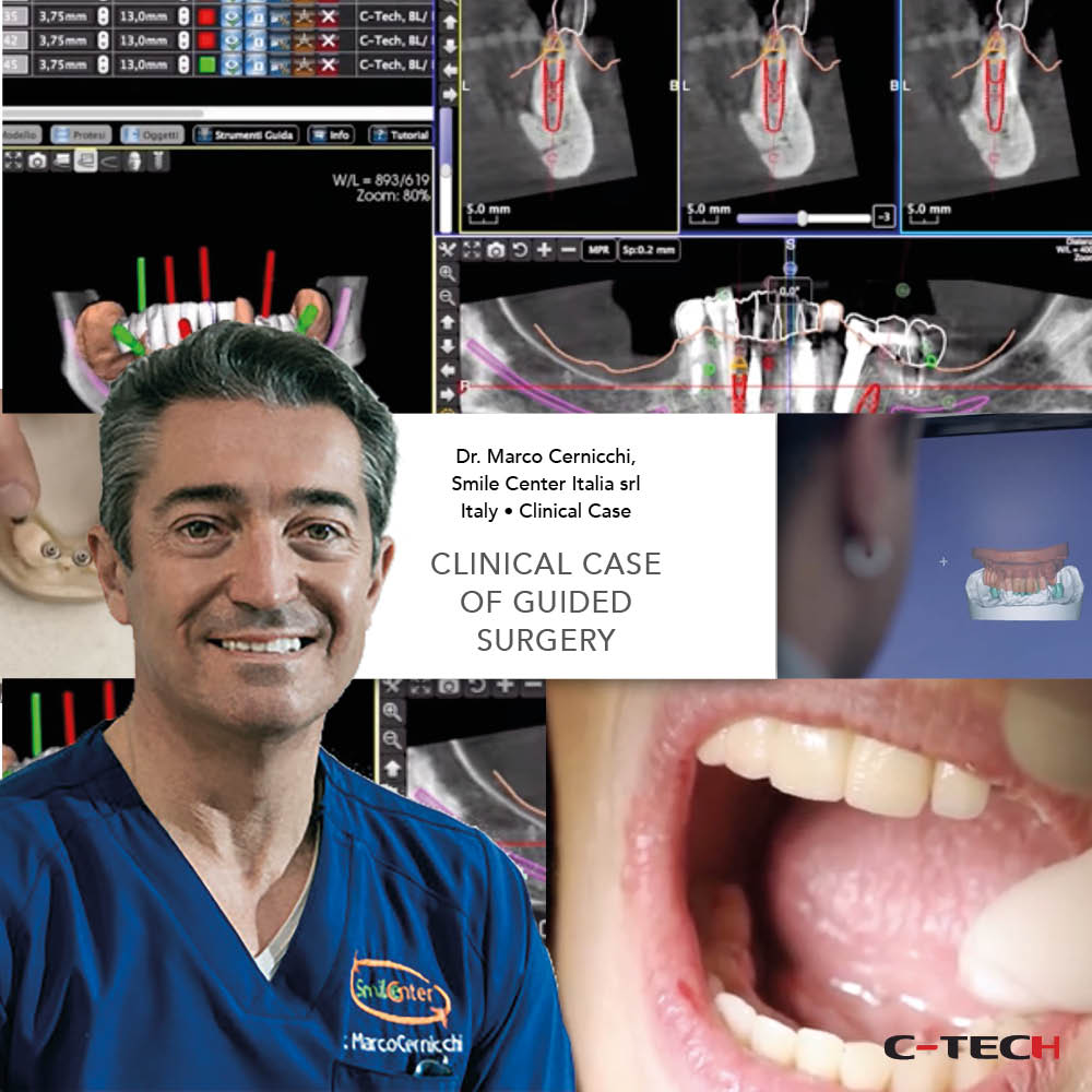 clinical-case-c-tech-implant-bologna-Clinical-Case-of-Guided-Surgery-marco-cernicchi