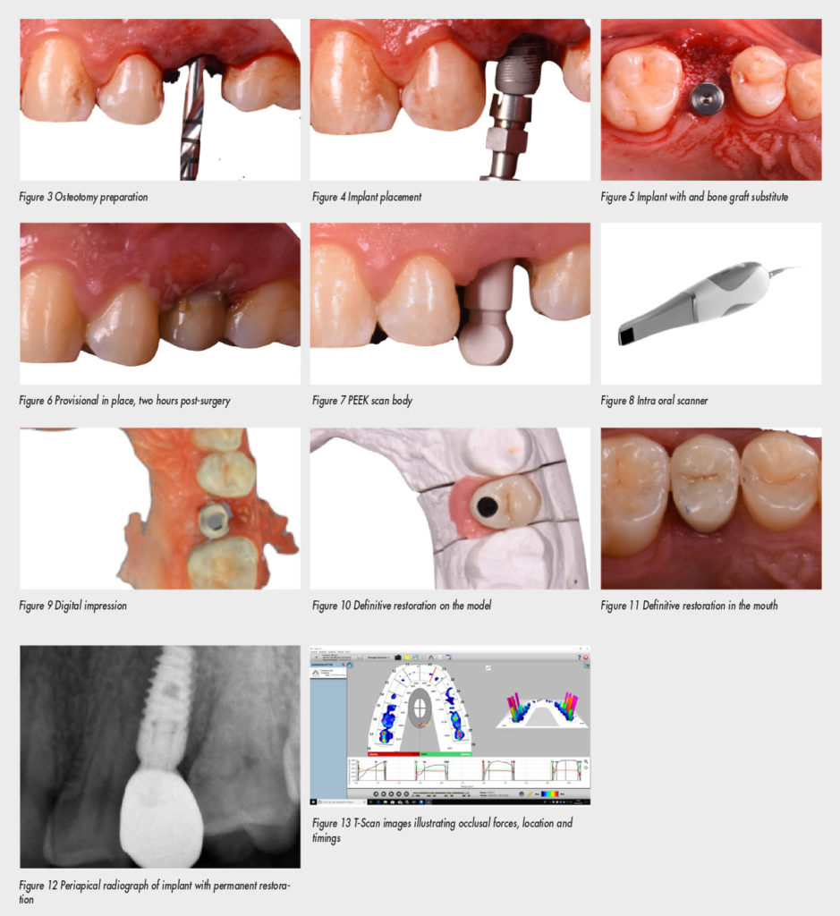 Extraction of a Fractured Upper Left Second Premolar, Conventional
