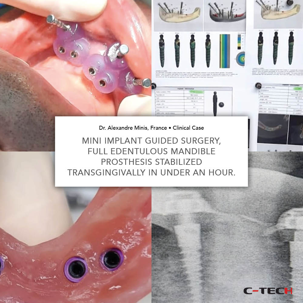 clinical-case-c-tech-implant-bologna-Mini Implant-Guided-Surgery-Full-edentulous-mandible-prosthesis-stabilized-transgingivally-in-under-an-hour-minis