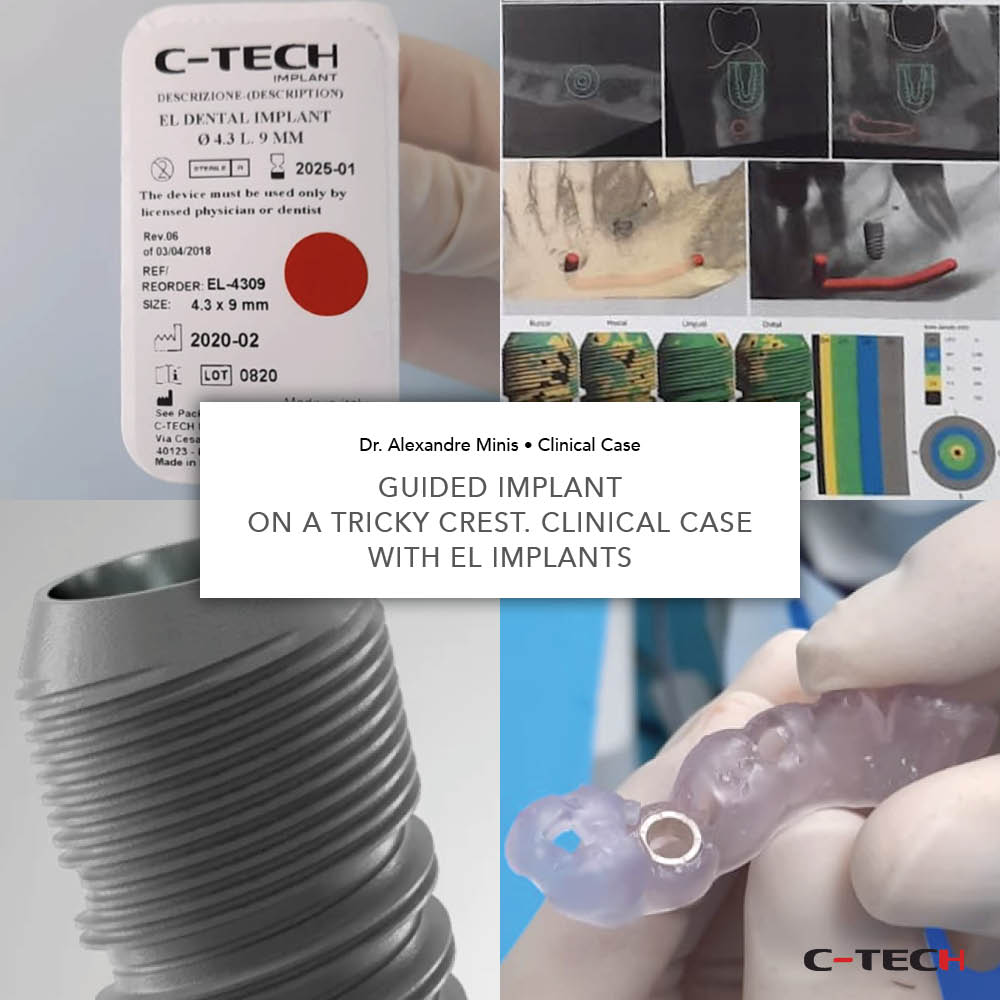 clinical-case-c-tech-implant-bologna-Guided-Implant-on-a-Tricky-Crest-minis