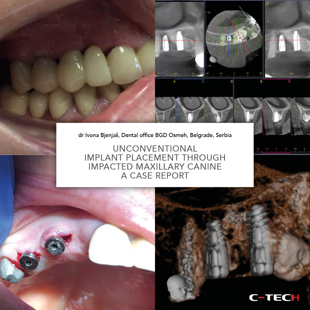 clinical-case-c-tech-implant-bologna-Unconventional-Implant-Placement-Through-Impacted-Maxillary-Canine-dr-Ivona-Bjenjas