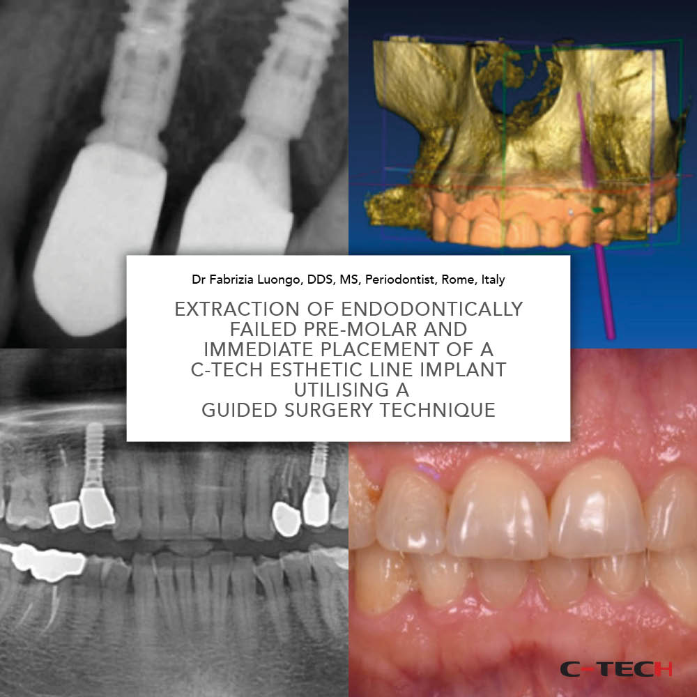 clinical-case-c-tech-implant-bologna-immediate-placement-of-a-C-Tech-Esthetic-Line-implant-utilising-Guided-Surgery-Technique-dr-luongo
