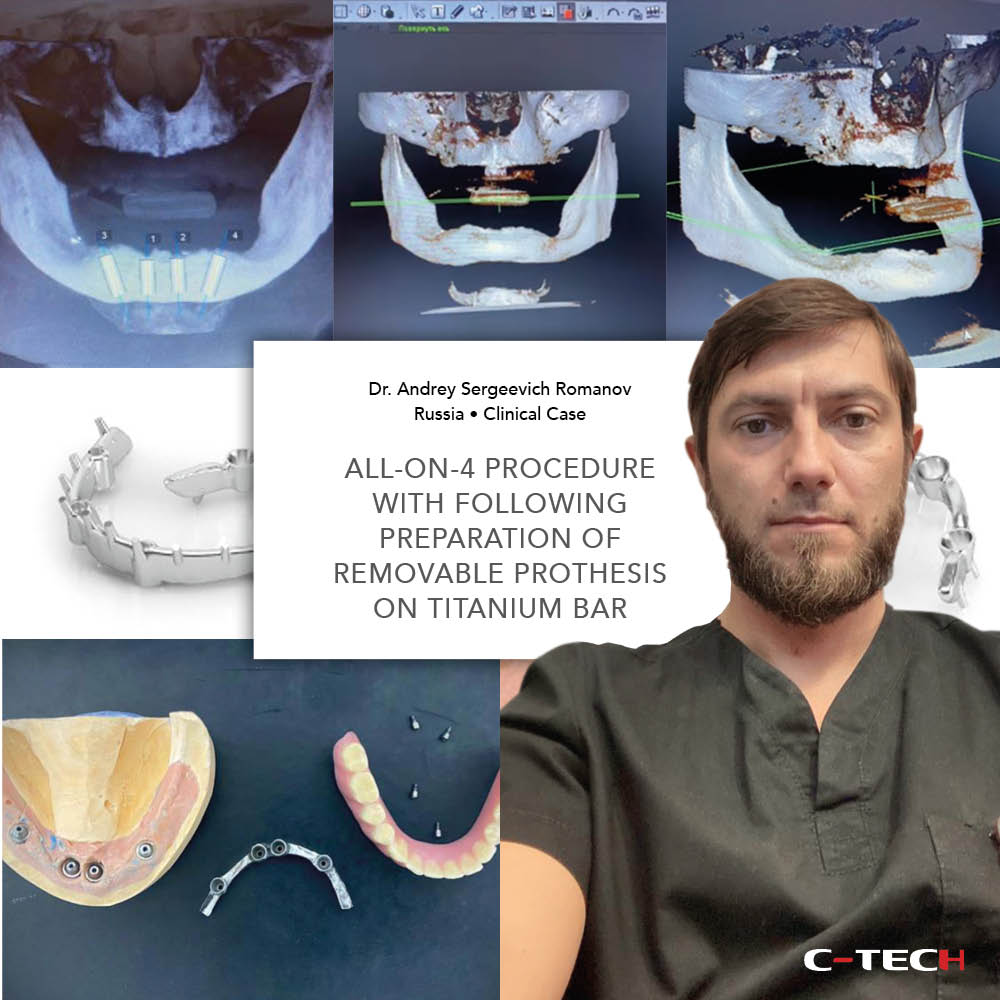 clinical-case-c-tech-implant-bologna-All-on-4 procedure-with-following-preparation-of-removable-prothesis-on-titanium-bar-Romanov