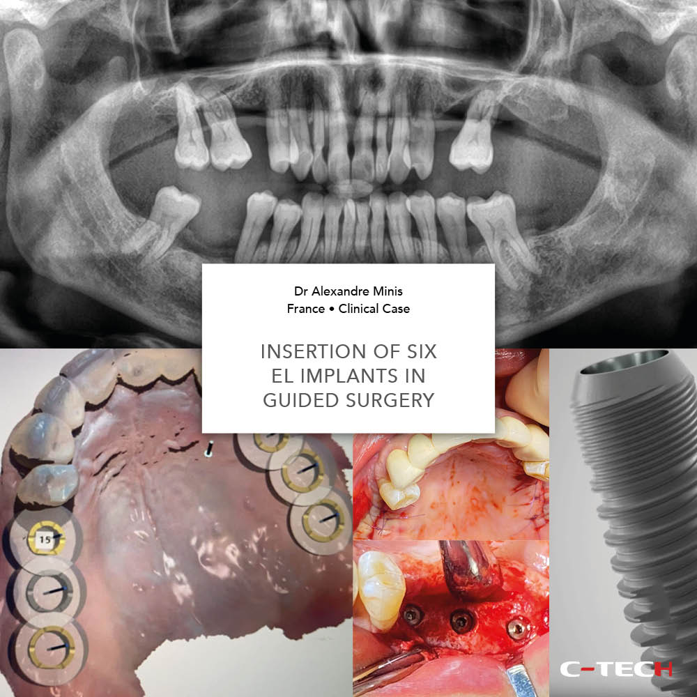 clinical-case-c-tech-implant-bologna-Insertion-of-six-EL-implants-in-guided-surgery-minis