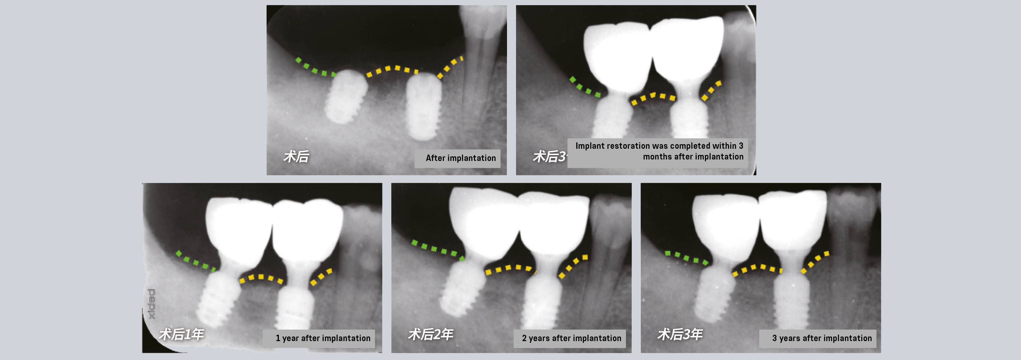 Effect tracking of bone stability Mandibular posterior area CTech