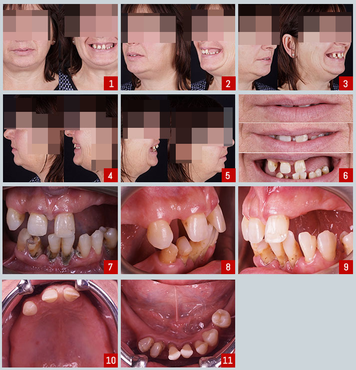Full arch case immediate implant placement with guided surgery and