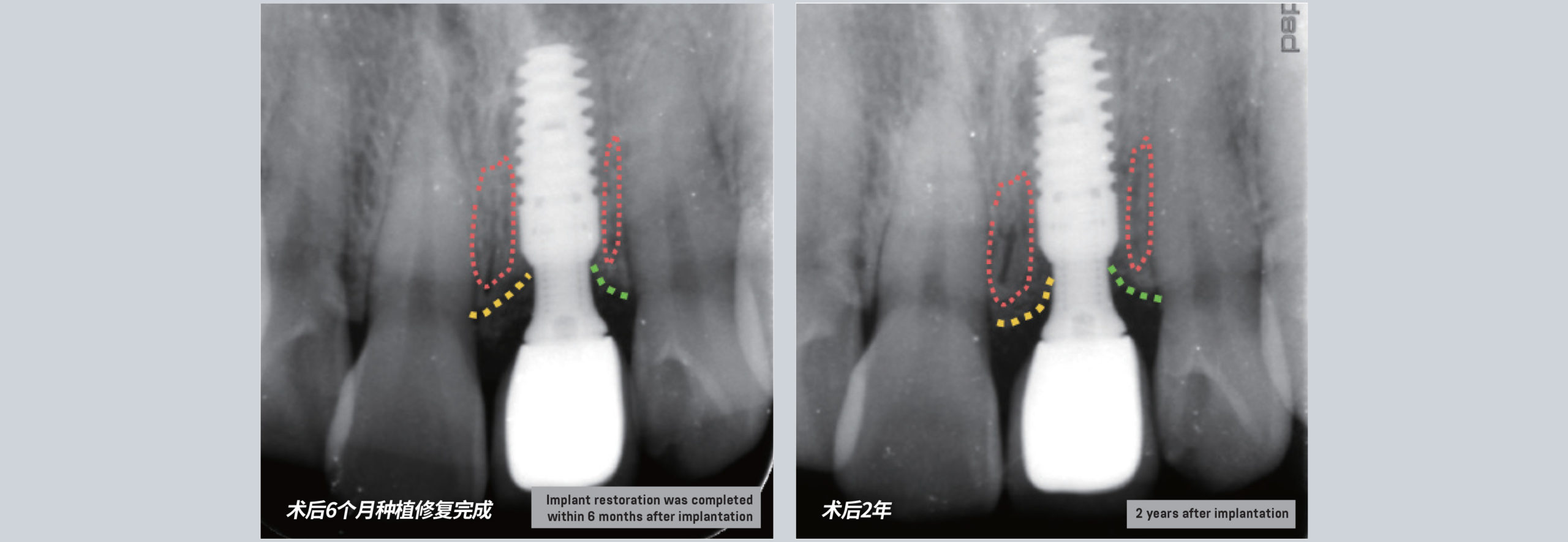 Effect tracking of bone stability Anterior area CTech Implant