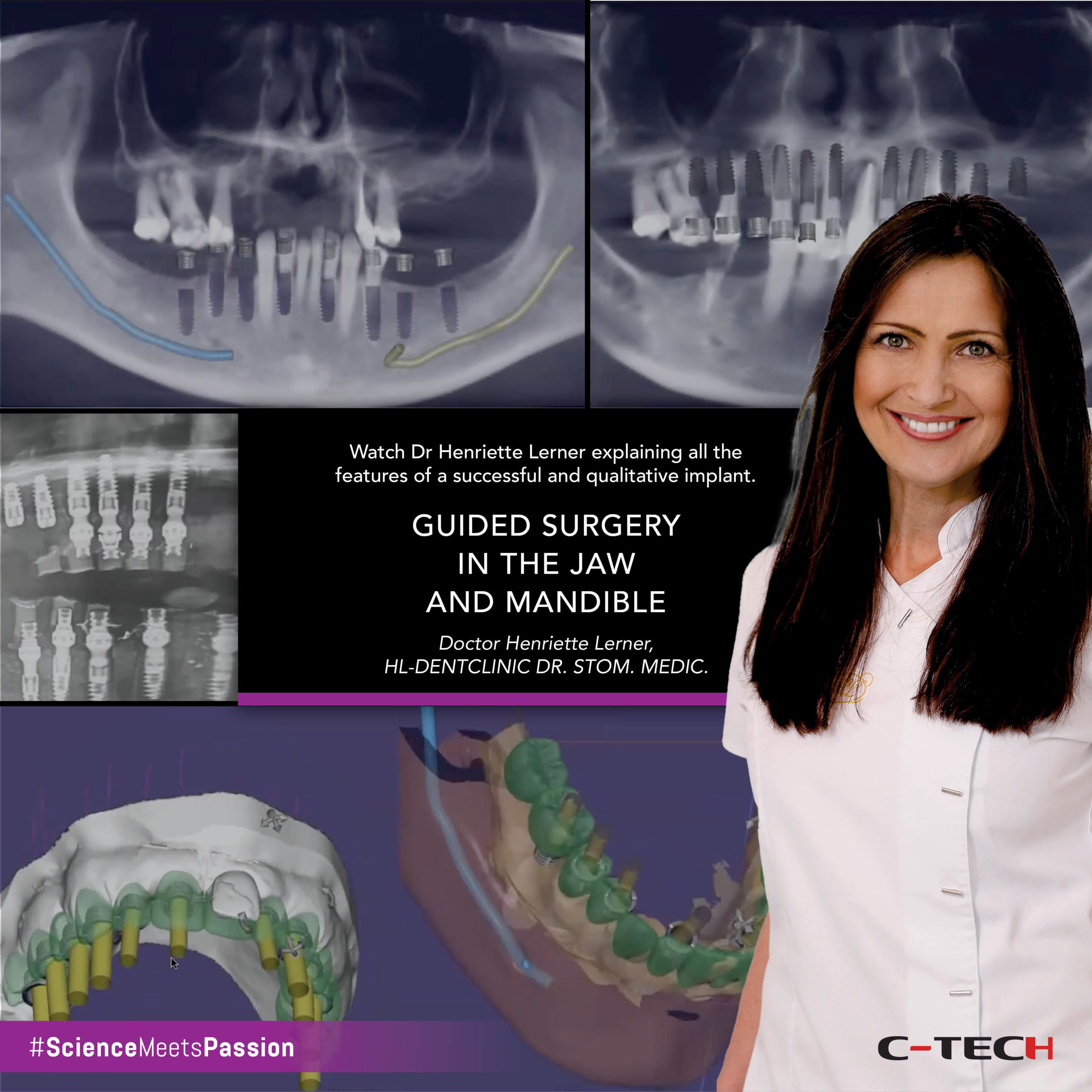 Guided surgery in the jaw and mandible CTech Implant Mini dental