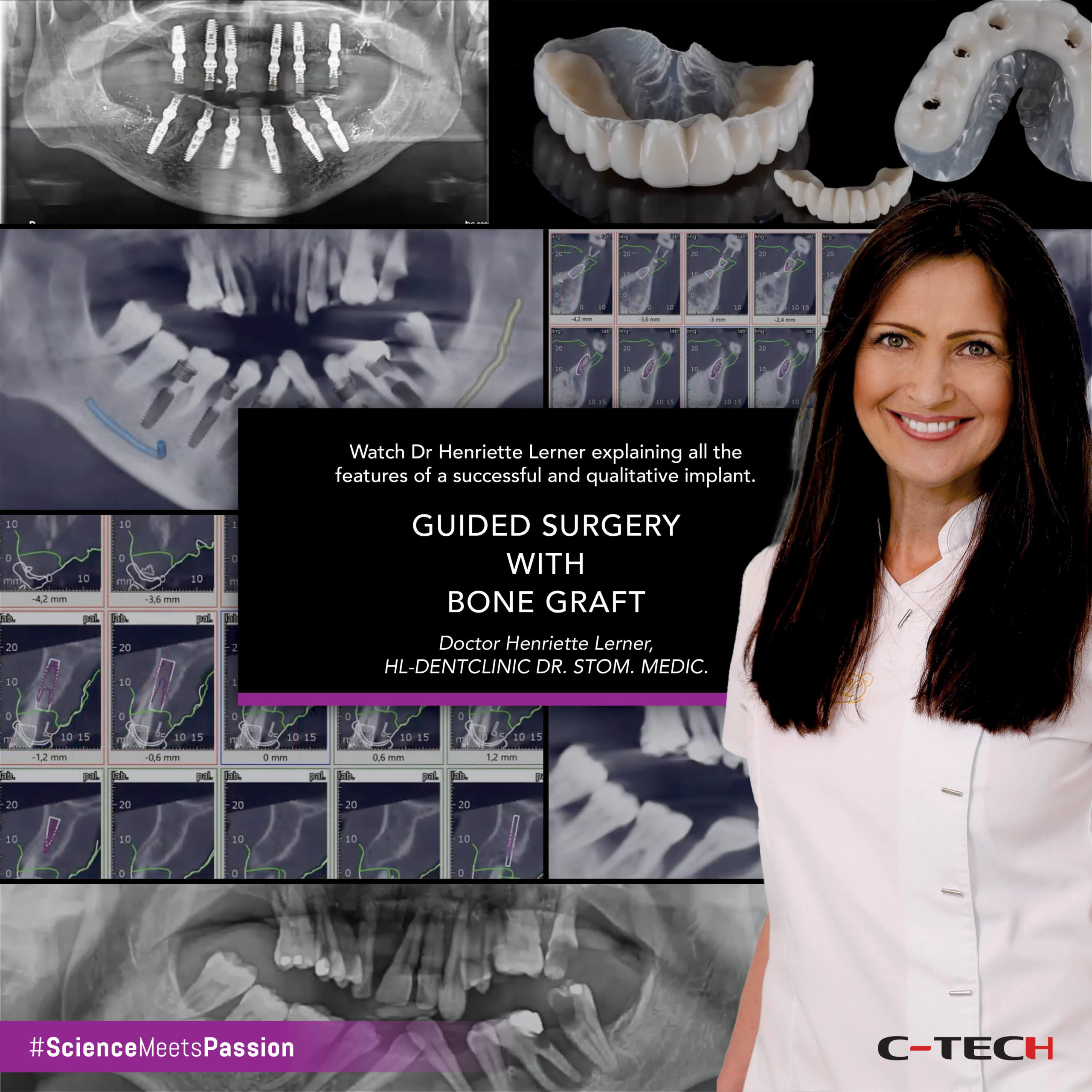 Guided surgery with bone graft CTech Implant Mini dental implants